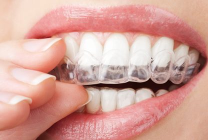 Chỉnh nha bằng khay - Aso Aligner Nhật Bản